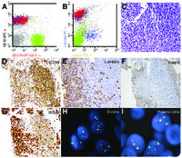 CD5/SOX-11 mantle cell lymphoma with concomitant monotypic plasmacytic differentiation