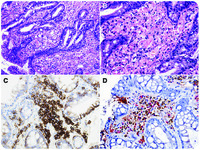 MOTT CELLS IN BONE MARROW ASPIRATE SMEARS