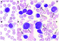 A deceiving cytopenia