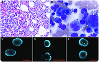 Plasma cell myeloma with anaplastic transformation