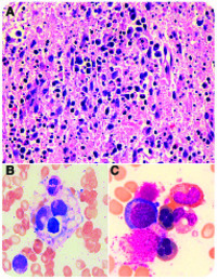 Dyserythropoiesis due to reactive hemophagocytic lymphohistiocytosis