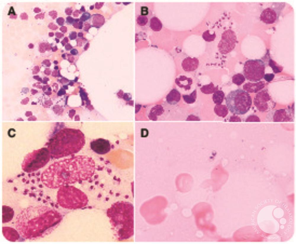 Pancytopenia caused by visceral leishmaniasis in a patient immunosuppressed after cancer therapy