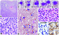 Bone marrow involvement of primary cutaneous γ/δ T-cell lymphoma