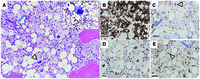 Histiocytic sarcoma: secondary neoplasm or “transdifferentiation” in the setting of B-acute lymphoblastic leukemia