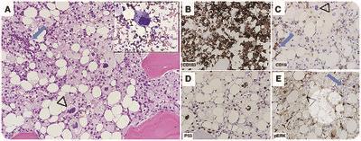 Histiocytic sarcoma: secondary neoplasm or “transdifferentiation” in the setting of B-acute lymphoblastic leukemia