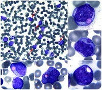 Pseudo Chediak-Higashi anomaly in acute monoblastic leukemia