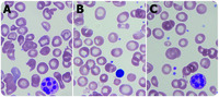 Characteristic peripheral blood smear findings in disorders of cobalamin metabolism