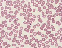 can-vitamin-d-deficiency-cause-low-platelets-wallpaper