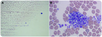 von Willebrand disease type 2B