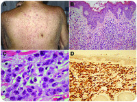 An unusual presentation of secondary AML