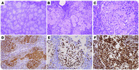 A rare histologic variant of a common lymphoma