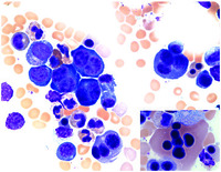 A striking bone marrow dyserythropoietic change but no anemia