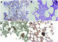 Nerves in bone marrow of newly diagnosed therapy-related acute myeloid leukemia