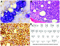 Near-triploid B lymphoblastic leukemia with Burkitt-like morphology