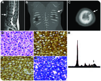 Pediatric multiple myeloma