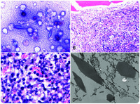 Charcot-Leyden crystals in T-cell lymphoblastic lymphoma