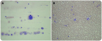 von Willebrand disease type 2B