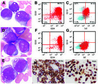 Blasts with abundant cytoplasmic granules: acute myeloid leukemia or granular acute lymphoblastic leukemia?