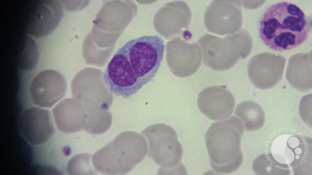 Persistent Polyclonal B-cell lymphocytosis (PPBL)