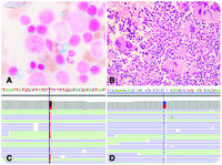 Myelodysplastic/myeloproliferative neoplasm with ring sideroblasts and thrombocytosis with co-mutated JAK2 and SF3B1