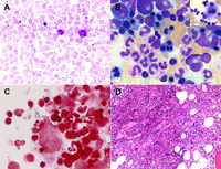 Mds Mpn With Ring Sideroblasts And Thrombocytosis Masquerading As