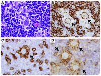 T-cell rosettes in nodular lymphocyte–predominant Hodgkin lymphoma