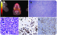 Kikuchi-Fujimoto disease