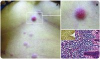 Dermal myeloid sarcoma as an initial presentation of acute myeloid leukemia