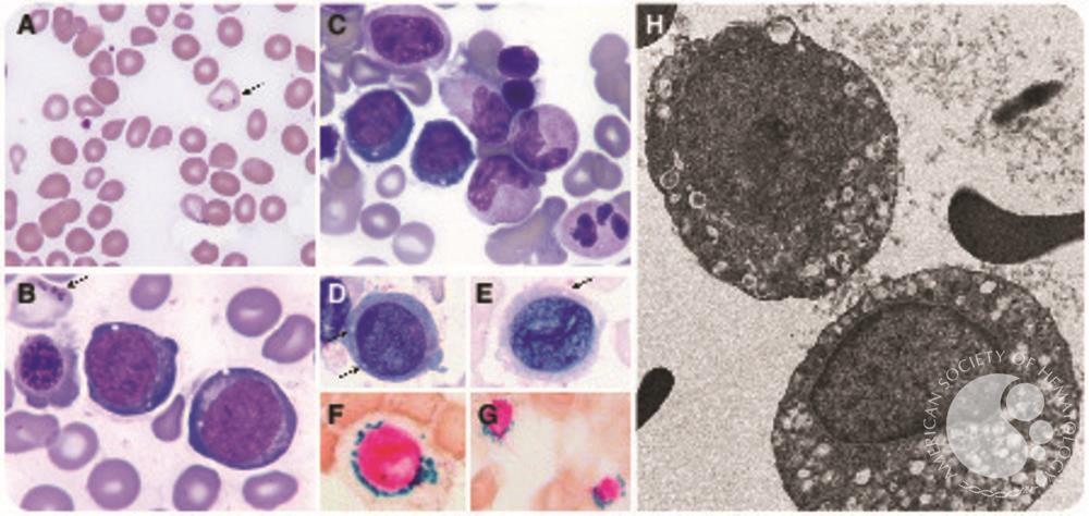 Morphologic features of normoblasts in a case of myopathy, lactic acidosis, and sideroblastic anemia