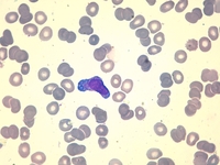 Auer rod-like inclusions in multiple myeloma 1