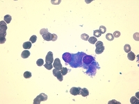 Auer rod-like inclusions in multiple myeloma 2