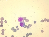 Auer rod-like inclusions in multiple myeloma 3