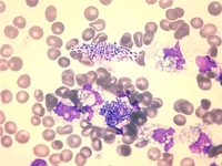 Free and intracellular bacteria on peripheral blood smear
