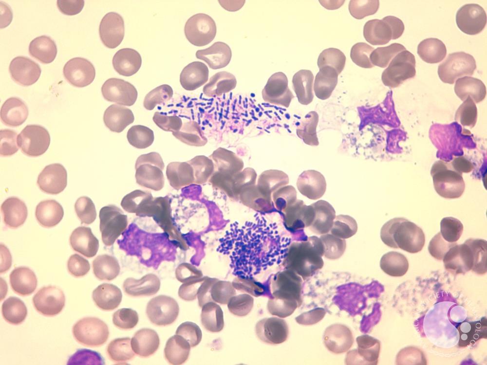 Free and intracellular bacteria on peripheral blood smear