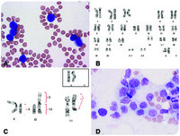 Donor-derived myeloid neoplasm post allogeneic hematopoietic cell transplantation