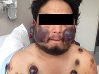 Initial skin lesion