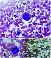 Flame cell in IgA monoclonal gammopathy of undetermined significance