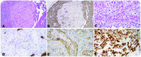 Incidental littoral cell angioma in refractory immune thrombocytopenic purpura