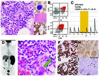 Langerhans cell histiocytosis in a patient with hairy cell leukemia: a tale of divergence