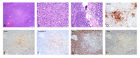 Plasmacytoid dendritic cells in lupus