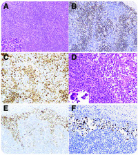 Peripheral T-cell lymphoma with EBV-infected “anaplastic” B-cell proliferation confined to sinuses