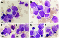 Variant ZBTB16-RARA translocation: morphological changes predict cytogenetic variants of APL