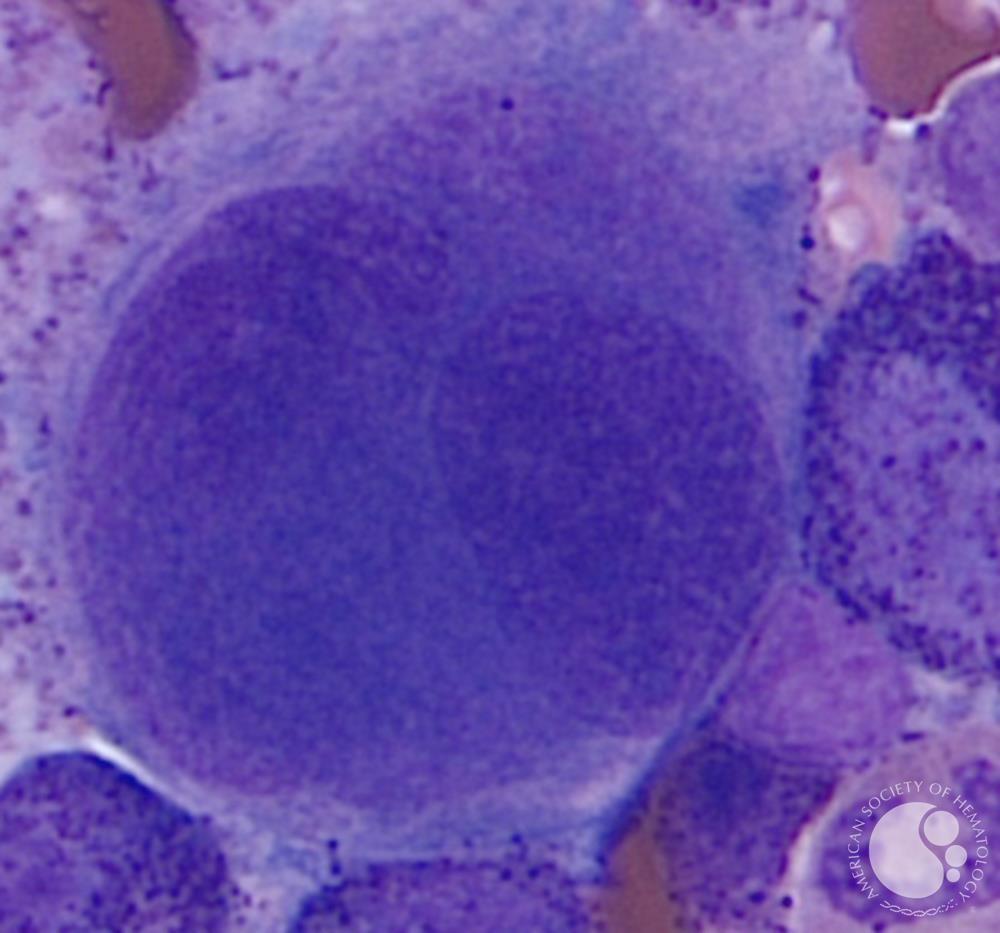 Atypical Megakaryocyte