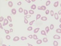 Tear drop cells (Dacrocytes) 1
