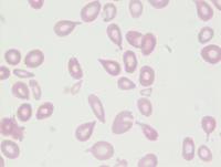 Tear drop cells (Dacrocytes) 3