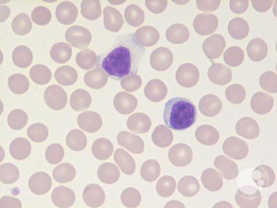 Large granular lymphocyte 1