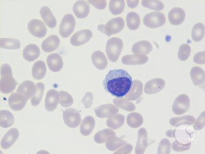 Large granular lymphocyte 2