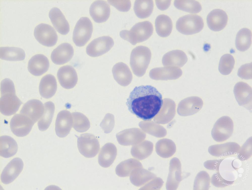 Large granular lymphocyte 2
