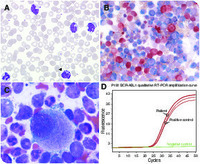 The thin line between CML and CMML