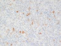 CD30-immunostain-in-AITL